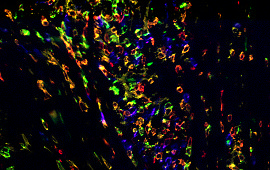 Bladder Transitional Cell Carcinoma: CD3, CD4, CD8, CD20 20x